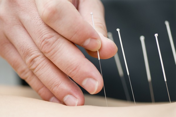 Séance acupuncture à Lyon